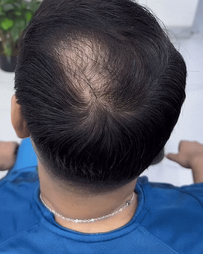 Regenesis™ – La solución para la zona adelgazada