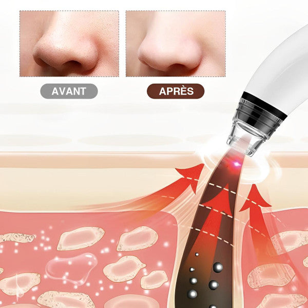 Pro Blackhead Vacuum Cleaner™ – Instant Results