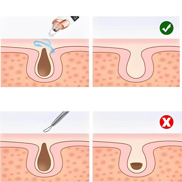 Pro Blackhead Vacuum Cleaner™ – Instant Results