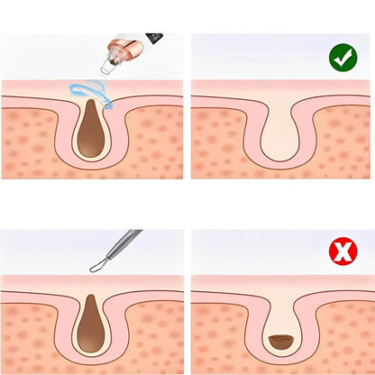 Pro Blackhead Vacuum Cleaner™ – Instant Results