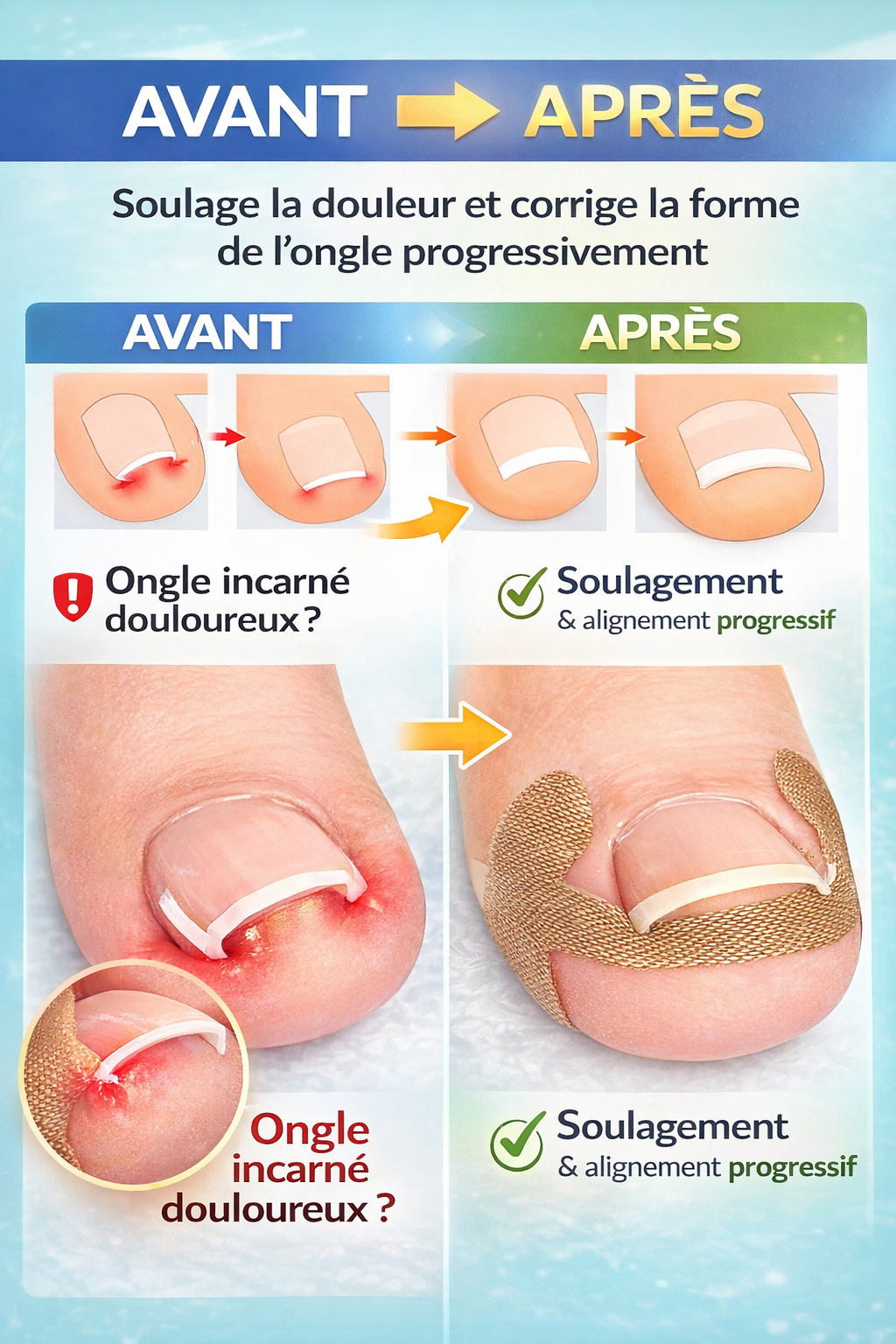 Kit Anti-Ongle Incarné – Soulagement Sans Douleur