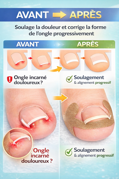 Kit Anti-Ongle Incarné – Soulagement Sans Douleur