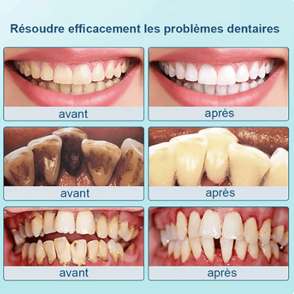 Détartrage Maison Pro™ – Le Kit Complet Pour Un Sourire Parfait