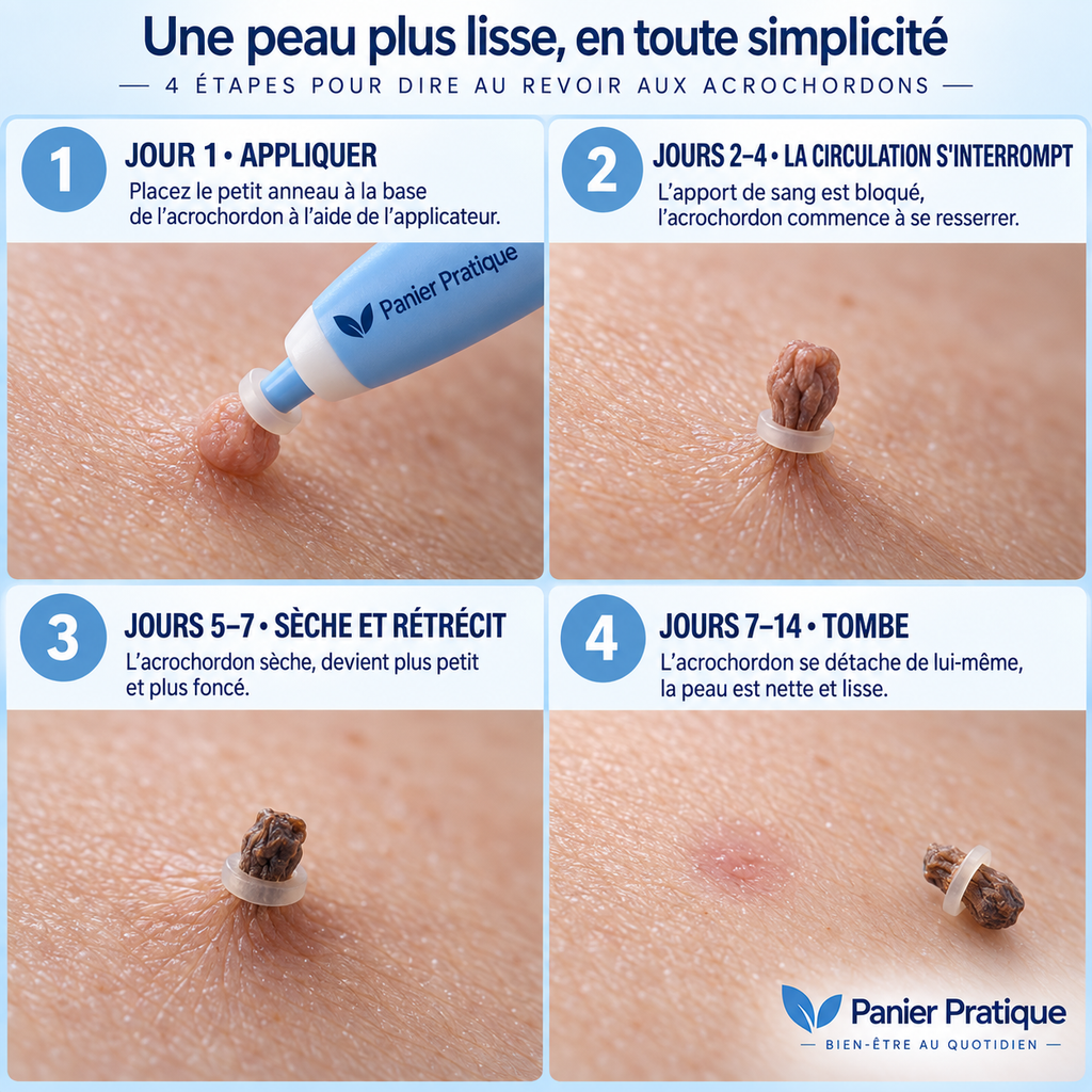 AcroPrécis — Applicateur à bagues pour acrochordons