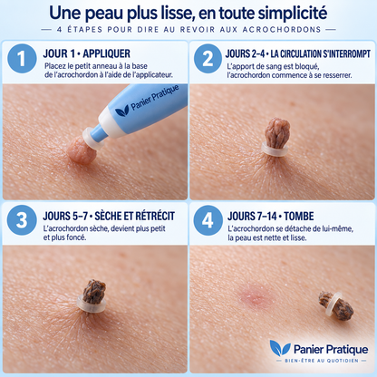 AcroPrécis — Applicateur à bagues pour acrochordons