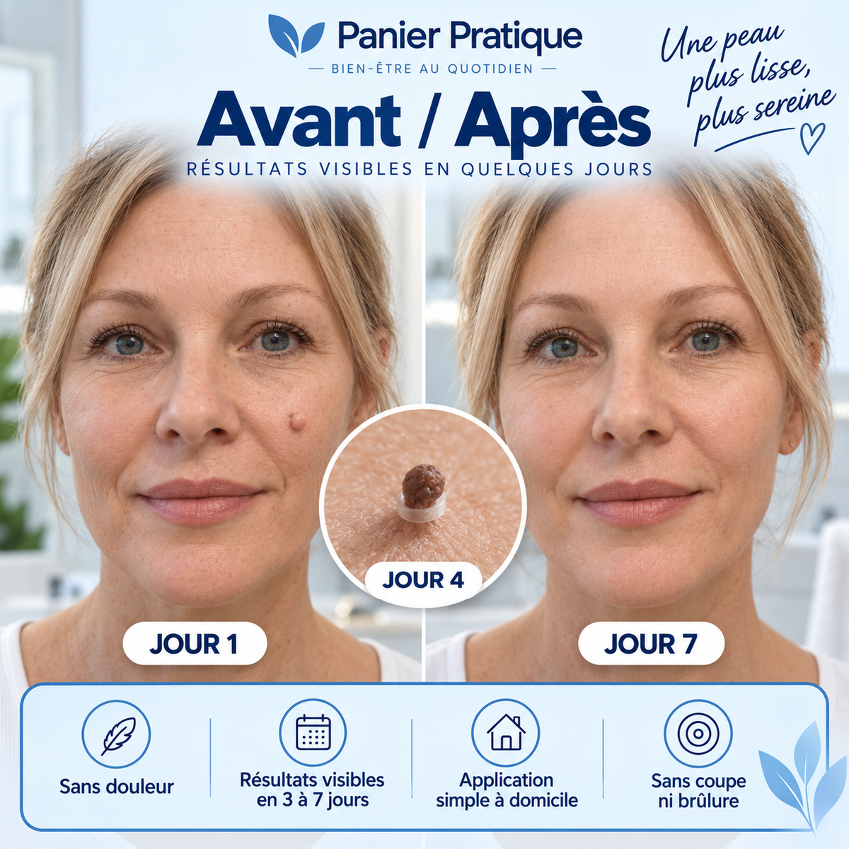 AcroPrécis — Applicateur à bagues pour acrochordons