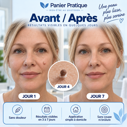 AcroPrécis — Applicateur à bagues pour acrochordons