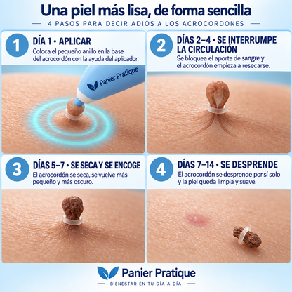 AcroPrécis — Aplicador de bandas para acrocordones