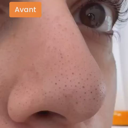 Mascarilla para puntos negros LANBÉNA™